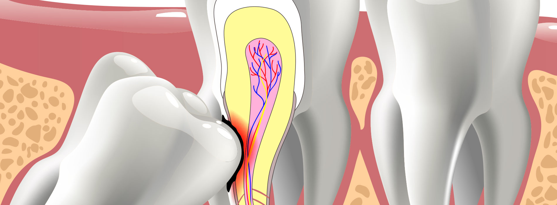 Impacted Wisdom Teeth Removal in Miramar Beach